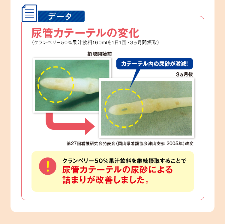 尿管カテーテルの変化の図